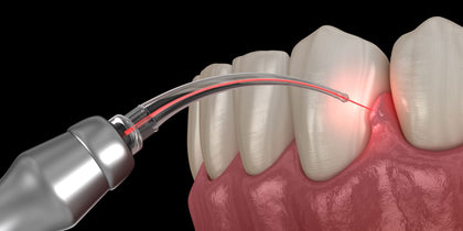 Diode Laser Applications for Dentists