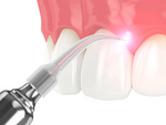 Diode Laser Certification for Registered Dental Hygienists