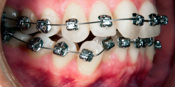 Orthodontic Module: Clinical Component – University of Alberta