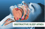 Complete OSA Program (pediatrics)